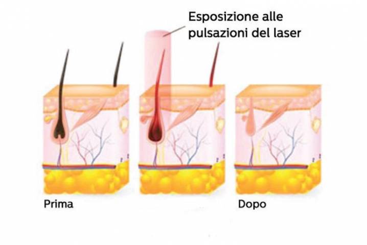 laser a diodo 