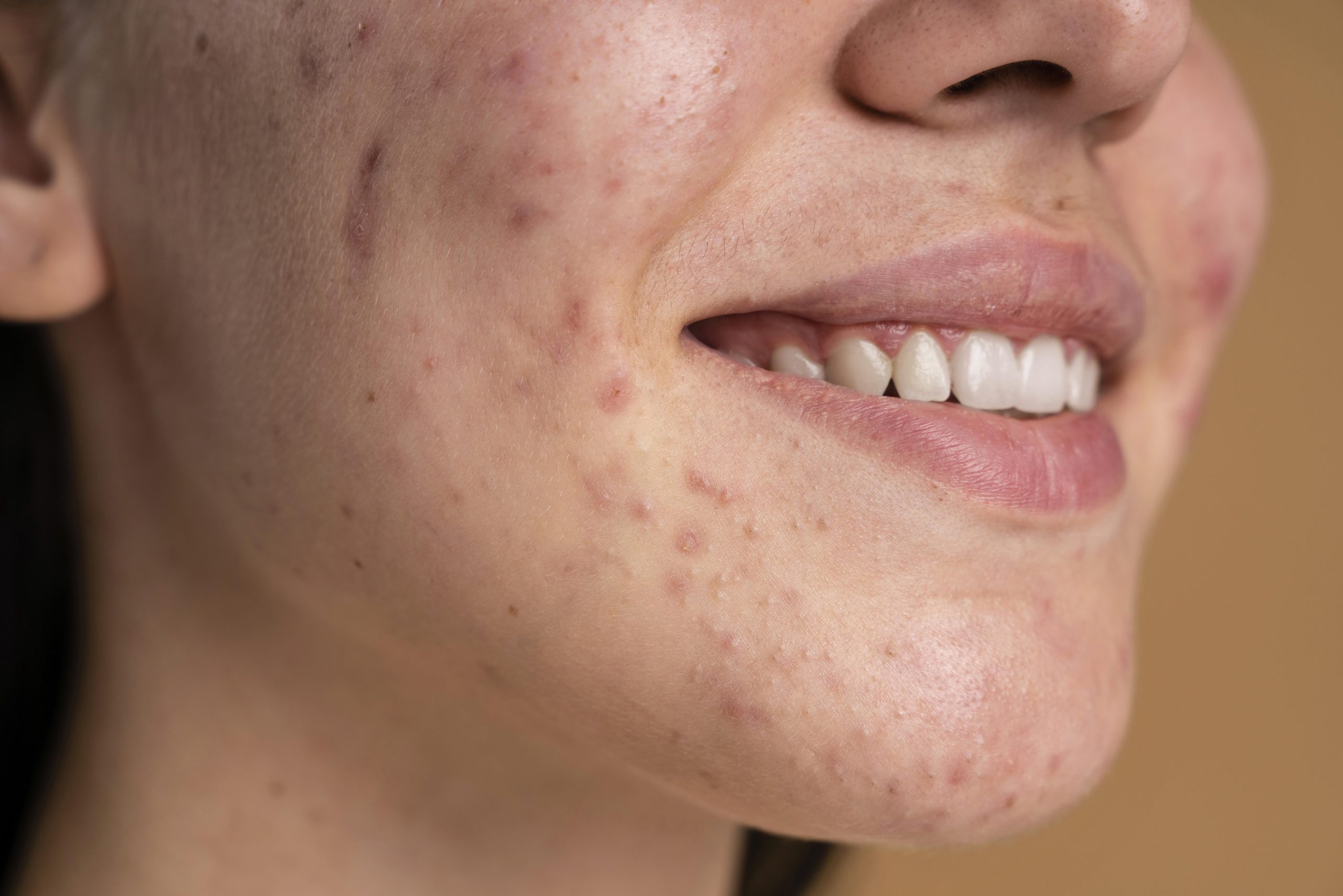 Acne Rosacea